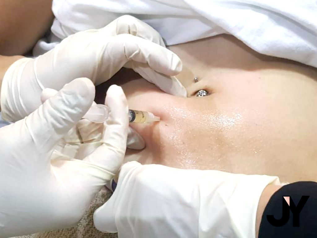 Mesolipo injected on the tummy area