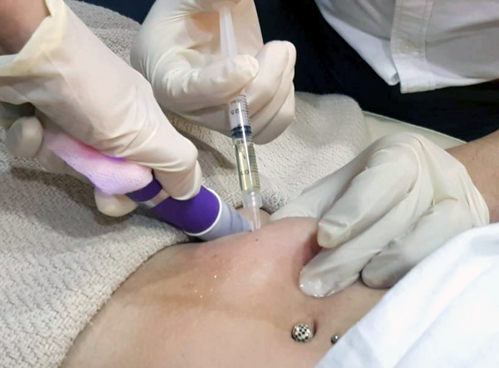 injecting on the tummy area to dissolve fats