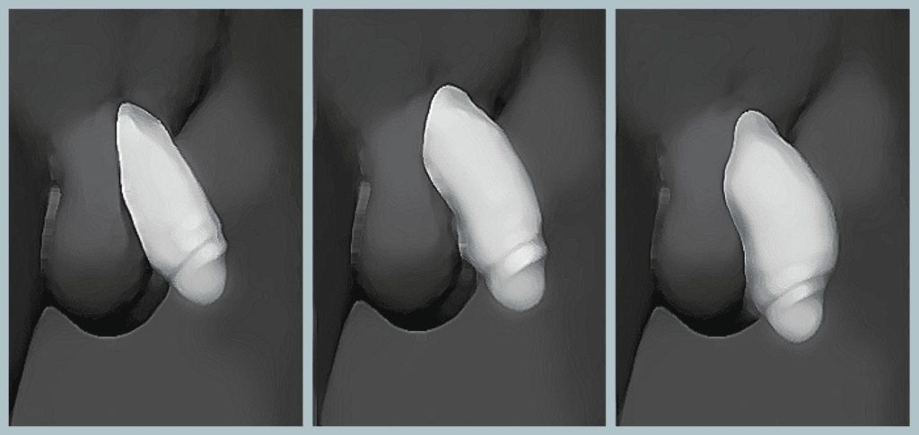 Premier Penis Enlargement Filler 