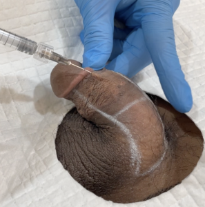 Premier Penis Enlargement Filler 