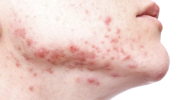 Acne Vulgaris