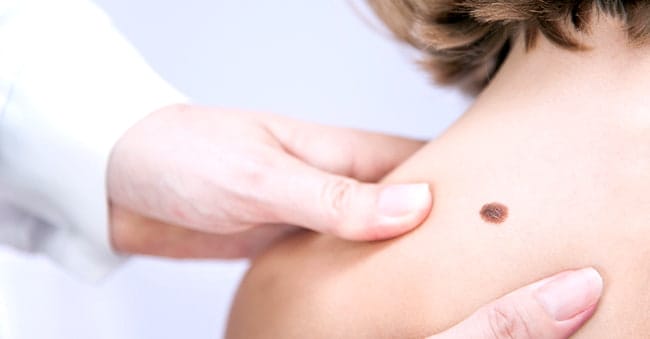 BIRTHMARKS