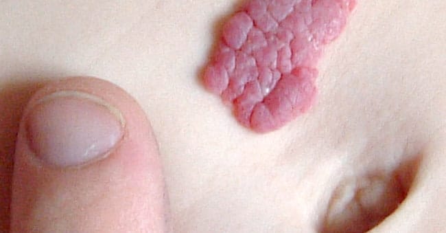 Hemangiomas