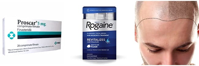How To Prevent Hair Loss man