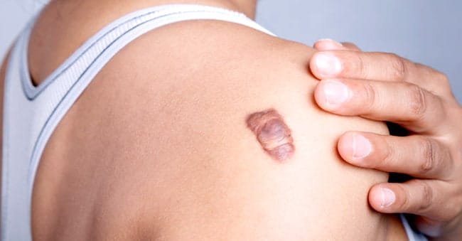 KELOID