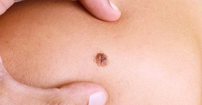 Moles