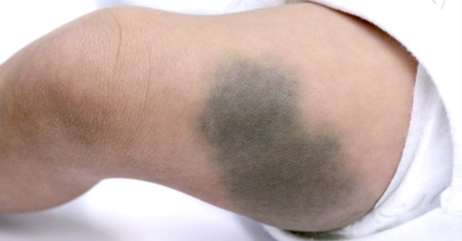 Mongolian blue spots