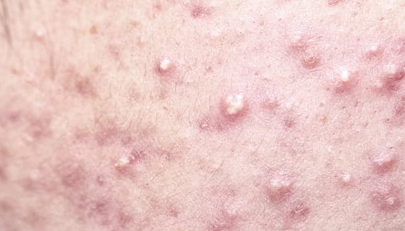 Pustules