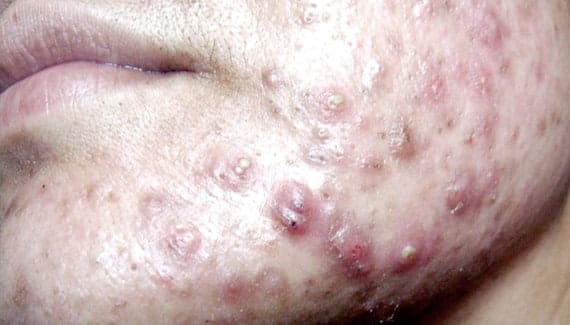 Severe Nodulocystic Acne: Inflamed pimple with pus and redness