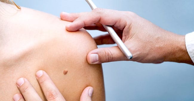 TREATMENTS BIRTHMARK-