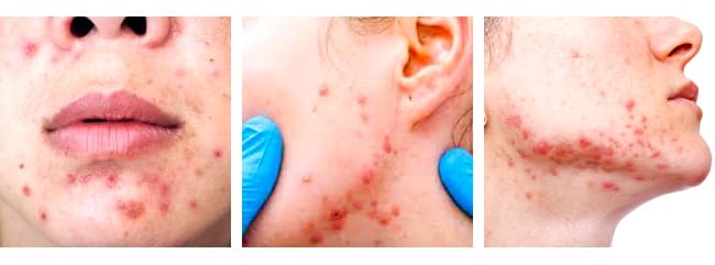 WHAT IS ACTIVE ACNE