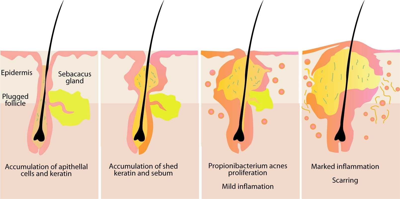 causes-of-acne