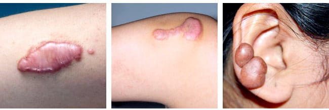 keloid scar