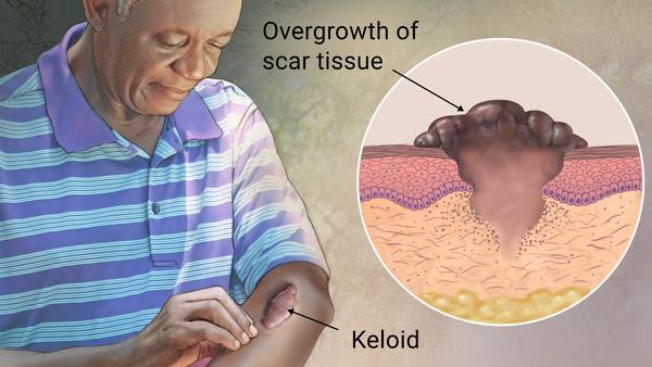 keloid scar