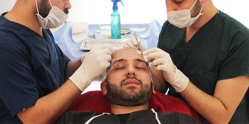 fue hair transplant