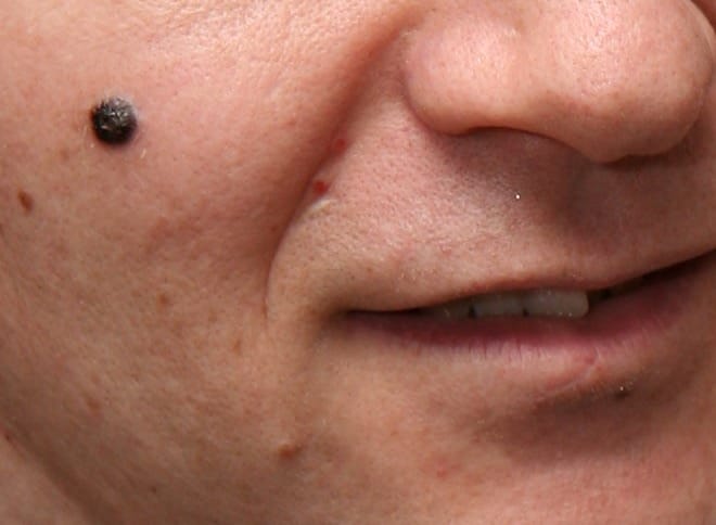 WHAT IS A MOLE
