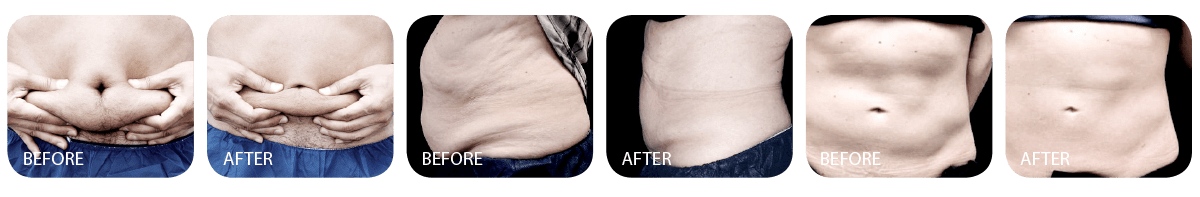 Cool Sculpting Promo before after