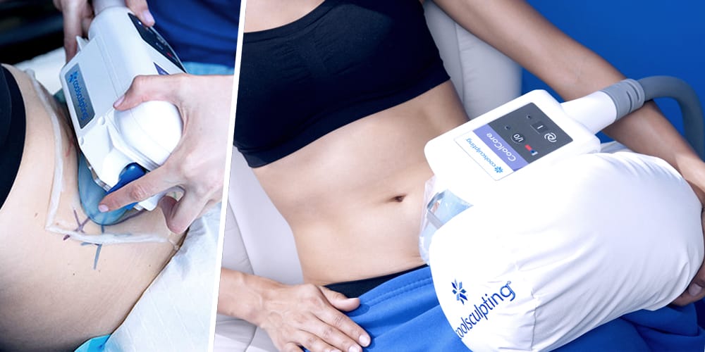 CoolSculpting