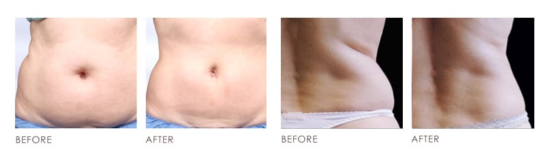 Fat Loss Before After 