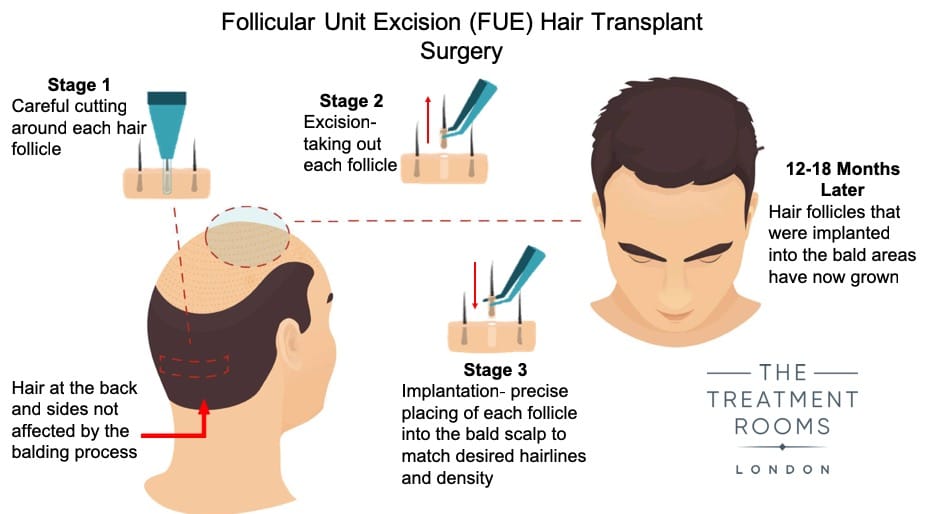 Hair-Transplant-Surgery-Diagram