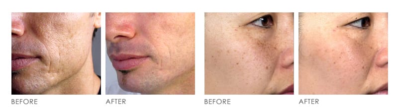 ED PHOTOTHERAPY before after