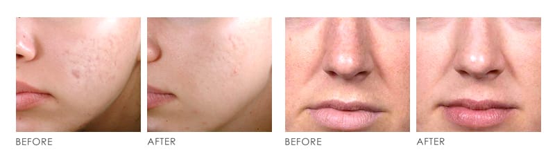 Microdermabrasion before after