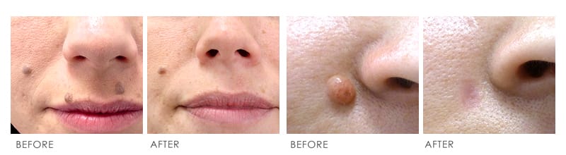Mole Removal Before & After