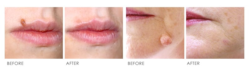 Mole Removal Before & After