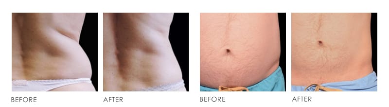Premier belly freeze Before After 