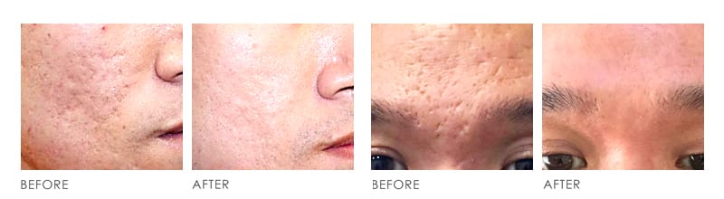 SKIN RESURFACING Before After