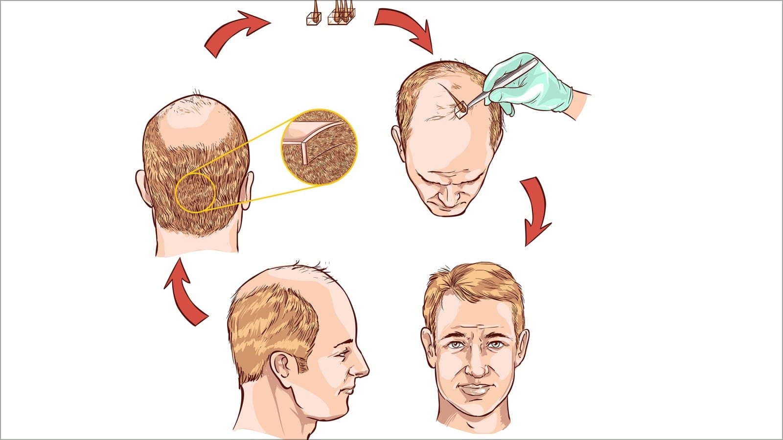 FUE Hair Transplant