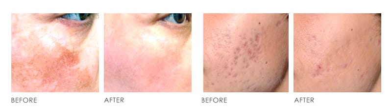 pico laser Before After 