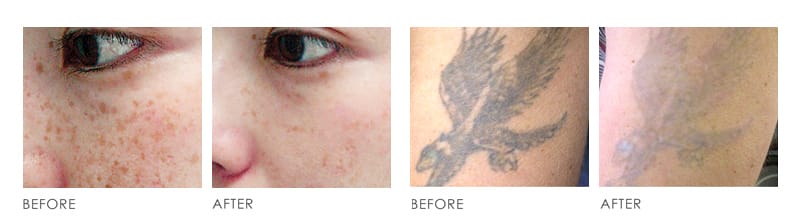 pico laser Before After 