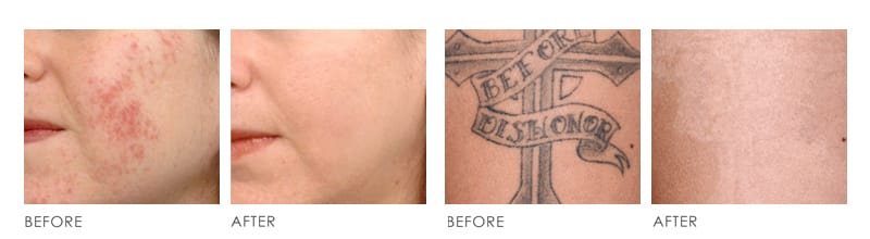 pico laser Before After