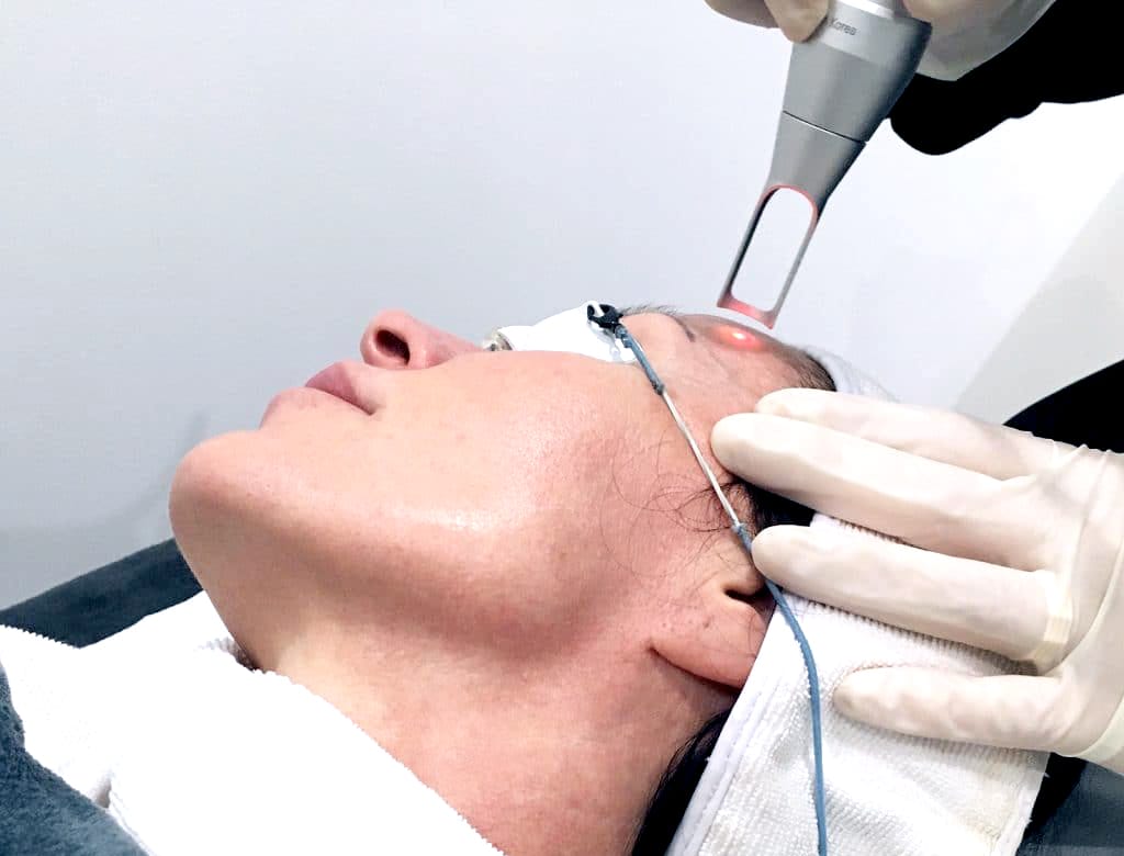 Fractional laser