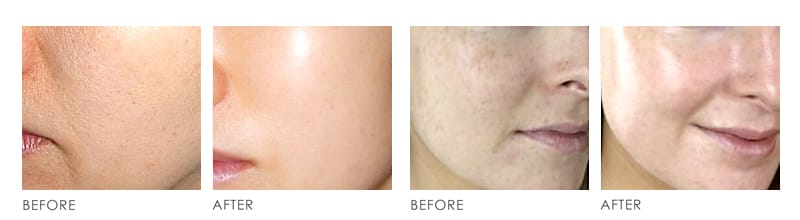 Stem Cell Before After