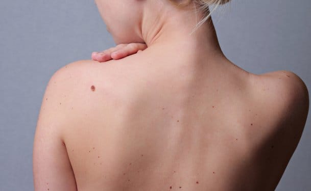 WHAT IS A MOLE