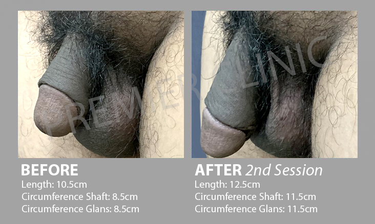 2nd Penis Enlargement Before After