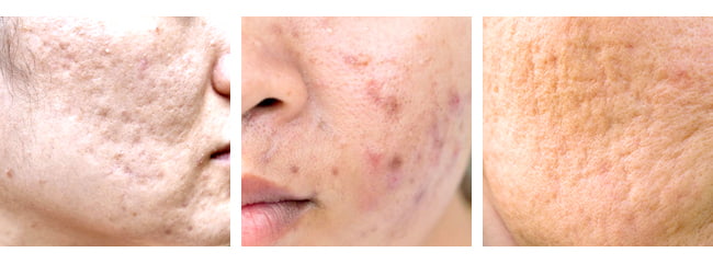 Acne scars