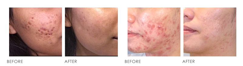 How to get rid of STUBBORN ACNE problem?