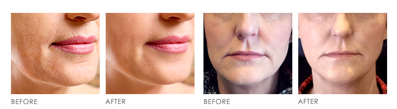 Anti Aging Before After
