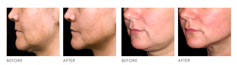 Anti Aging Before After
