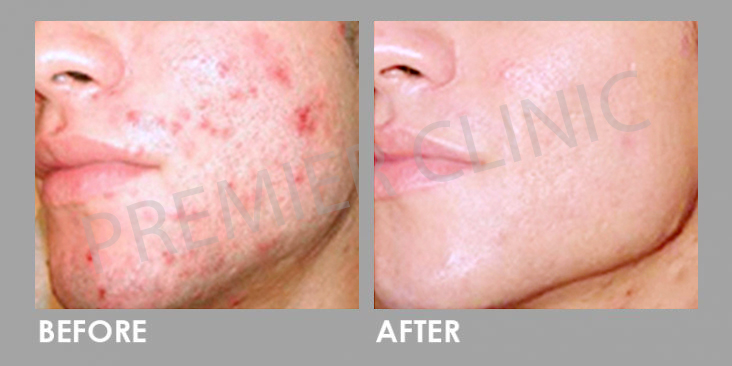 Anti Ance Before After 