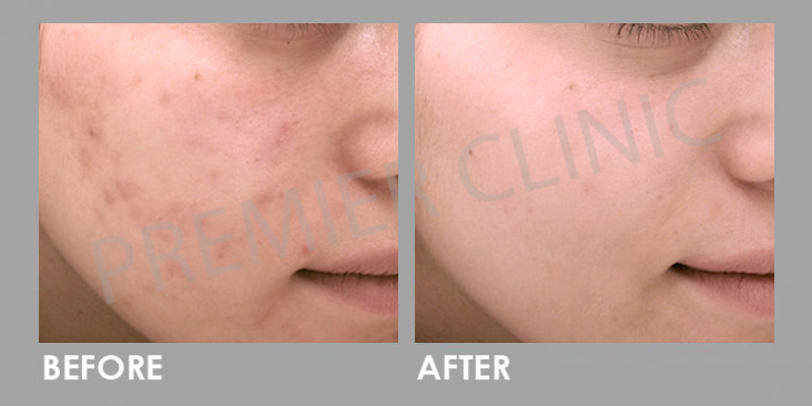 Anti Ance Before After 