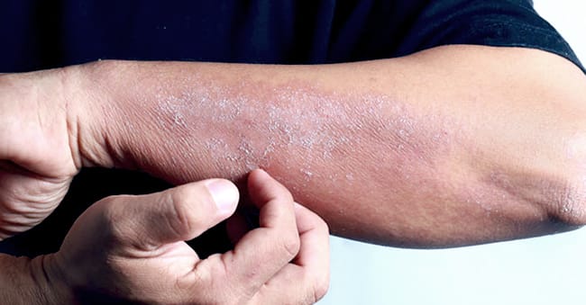 Atopic dermatitis