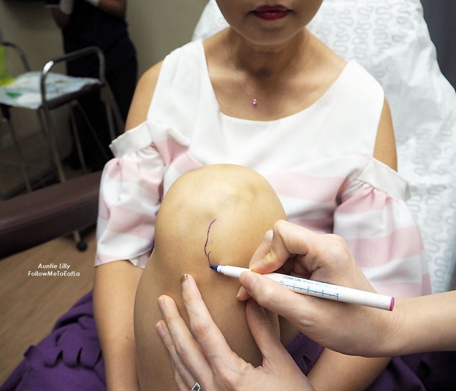 getting ready for prp injection
