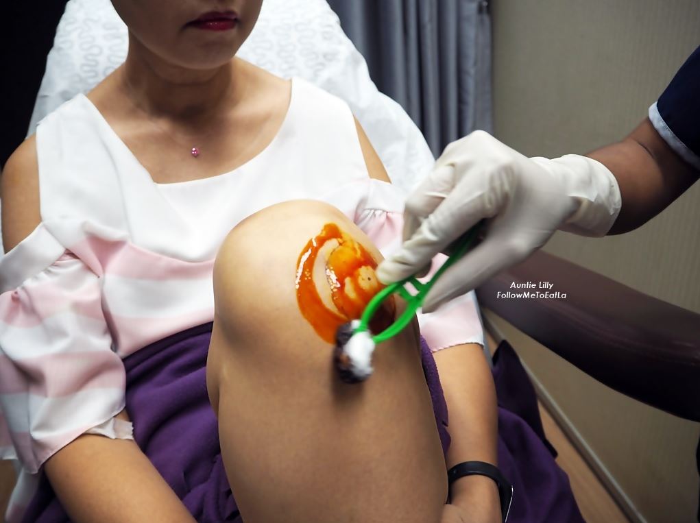 getting ready for prp injection