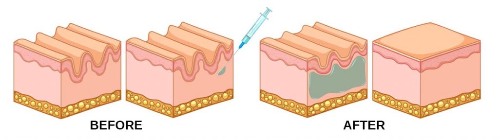 BOTULINUM TOXIN WORK 