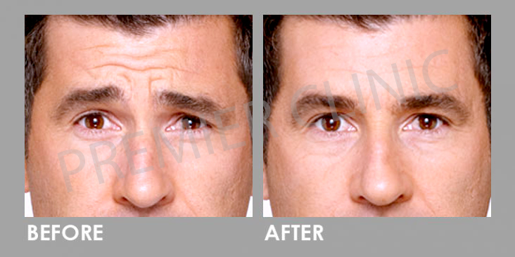 Before & After Botulinum Toxin