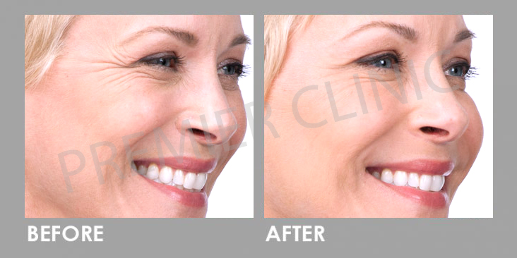 Before & After Botulinum Toxin